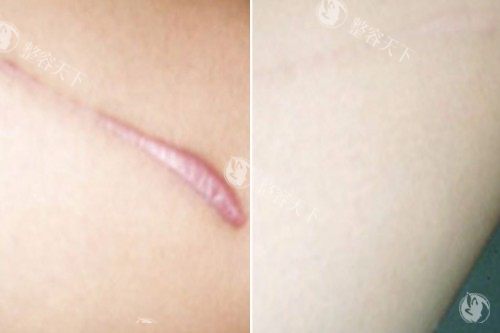 上海美莱疤痕修复怎么样？十年医师团队定制方案，胎记痘印分层治疗术例，快速修复肌肤平整无痕~