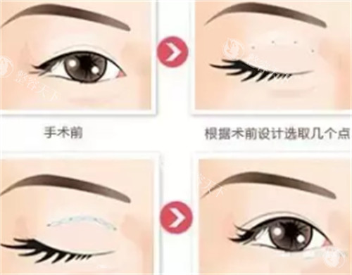 蒲于红做眼修复好吗？眼修复综合整形手术蒲于红技术相当好！