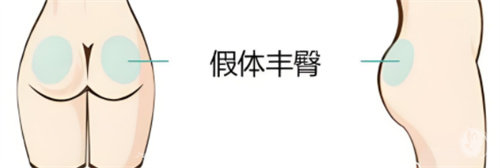 丰臀手术是假体的好还是自体脂肪填充的好？点击这里多角度帮你对比分析