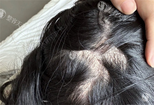 重庆唐森植发医院李少雄医生：提出 M + 艺术美植技术，让毛发种植更符合东方审美！