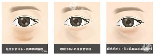眼底脂肪重排多少钱？能维持多久？和去眼袋是一样的吗？