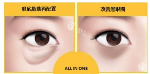 眼底脂肪重排多少钱？能维持多久？和去眼袋是一样的吗？