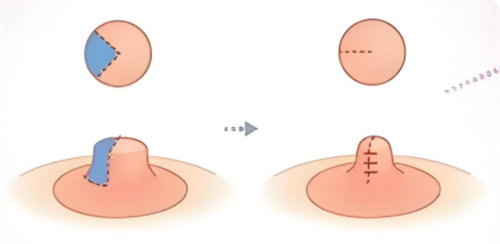 乳头缩小手术可靠吗？有没有风险？修复要多久？一文给你讲清楚