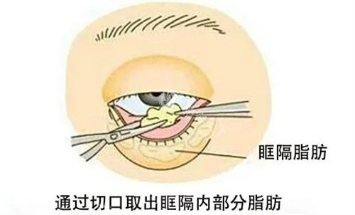 眼底脂肪重排多少钱？能维持多久？和去眼袋是一样的吗？
