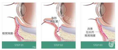 眼底脂肪重排多少钱？能维持多久？和去眼袋是一样的吗？