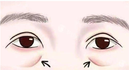 泪沟型眼袋怎么去除？这些日常护理/医美手段方法真的有效，很多人不知道！