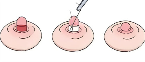 乳头缩小手术可靠吗？有没有风险？修复要多久？一文给你讲清楚