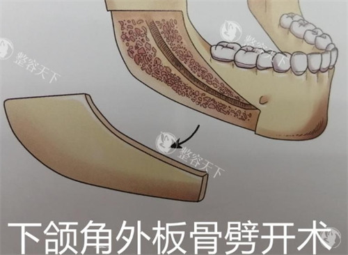 成都现代刘亚平医生怎么样？刘亚平做颌面整形手术技术非常好！