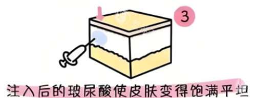 黄海燕进行玻尿酸注射结果如何？​在玻尿酸注射方案设计上，黄海燕医生重视个性化与整体协调