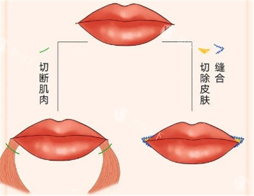 微笑唇整形手术多少钱？2025价格解析+避坑指南，一篇看懂！