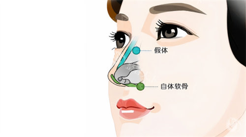 耳软骨隆鼻可以维持多久？2025解读：从5年到“长期定型”的真相在这里！
