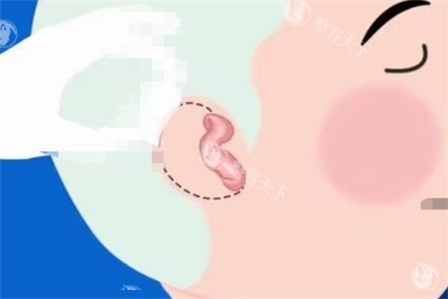 想了解庄洪兴还做耳再造手术吗？深入揭秘耳再造手术现状与庄洪兴医生动态！