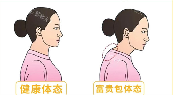 富贵包去除手术原理大揭秘：脂肪溶解+皮肤收紧如何重塑天鹅颈？