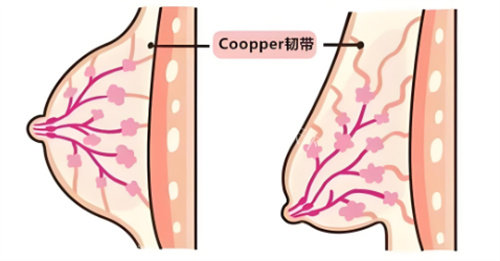乳房下垂割皮手术全解析：术后修复期如何护理？过来人分享真实体验