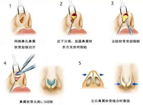 手术缩鼻翼内切和外切如何选择？从手术原理、结果、风险、适用人群等对比