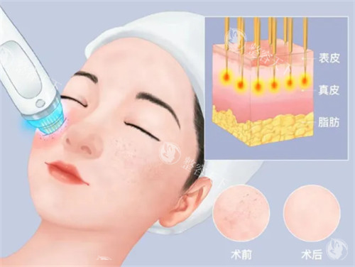 疑惑黄金微针真的能缩小毛孔吗？看看不同人群治疗反馈、适用范围及医生建议！