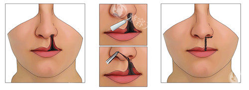 医院唇裂修复费用表一览!单侧1.2万起,双侧修复价格大公开