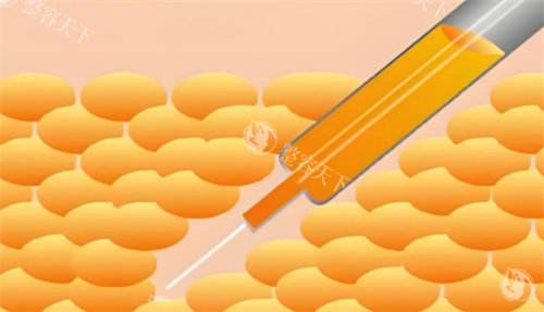 王仁根吸脂技术到底做的咋样？腰腹吸脂保留1cm脂肪层防松弛|用户亲测三个月后皮肤紧致如初