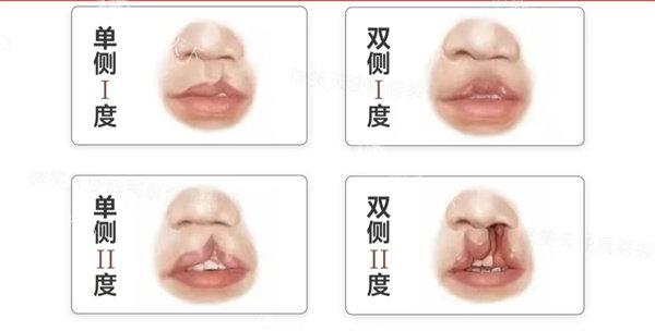 合肥唇裂修复医生哪个靠谱？王明刚医生技术亮点和用户评价来揭秘！