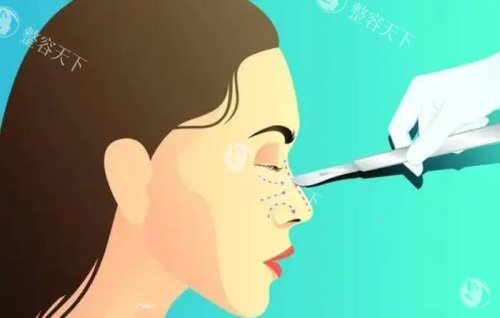 合肥维多利亚整形徐和林做鼻子怎么样?膨体/肋软骨精细化雕刻,可3D模拟自然鼻型
