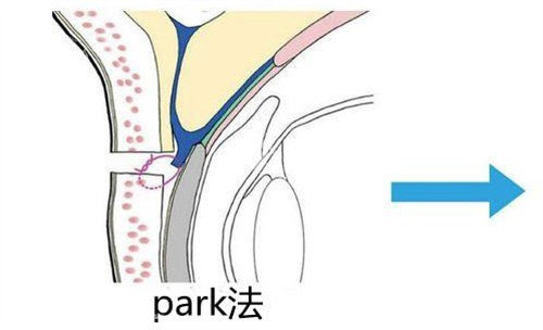 沈阳杏林张莹莹双眼皮怎么样？自然扇形设计+内折式缝合|肿胀轻微1个月修复自然|告别假宽深！