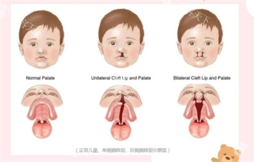 医院唇腭裂挂什么科室?别犹豫啦!直接唇腭裂正畸专科门诊,靠谱修复口碑好!