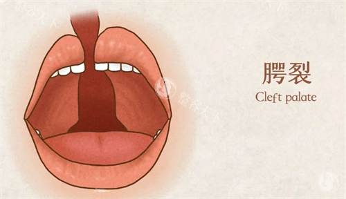医院唇腭裂挂什么科室?别犹豫啦!直接唇腭裂正畸专科门诊,靠谱修复口碑好!
