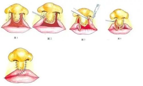 合肥唇裂修复医生哪个靠谱？王明刚医生技术亮点和用户评价来揭秘！