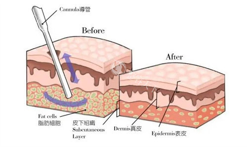 脂雕和抽脂区别何在？原理大不同：抽脂负压吸脂减脂肪量，脂雕激光精塑线条，适用部位各异！