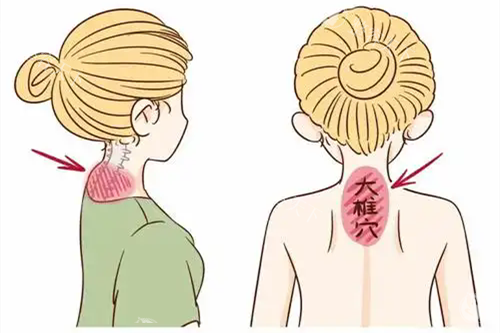 一针消除富贵包真的靠谱吗？专科医生告诉你真相，这些注意事项一定要知道！