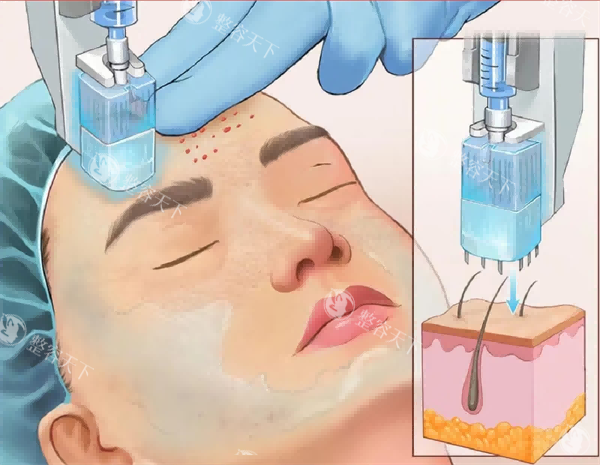 水光怎么打?打水光痛吗?一篇文章为您讲清楚：作用、价格、疼痛度！