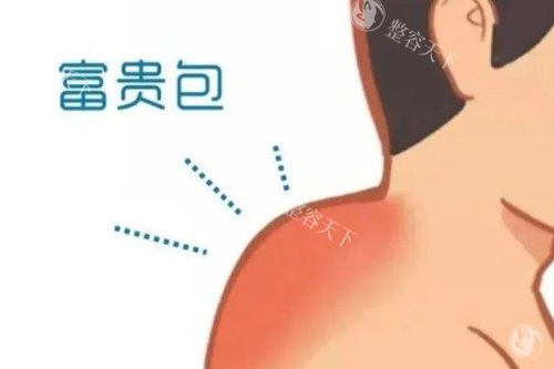 一针消除富贵包真的靠谱吗？专科医生告诉你真相，这些注意事项一定要知道！