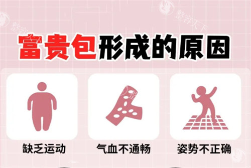 一针消除富贵包真的靠谱吗？专科医生告诉你真相，这些注意事项一定要知道！