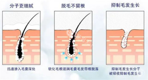 脱毛冰点和激光的区别以及选择哪种方法比较好，一文讲清利弊和费用！