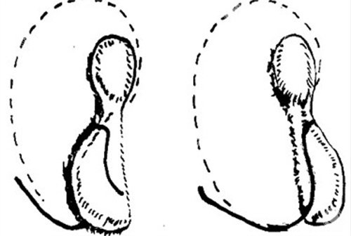 反骨耳矫正手术值得做吗？术后修复、价格、医生选择全攻略！