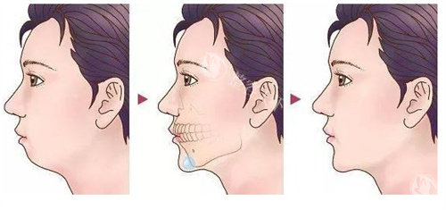 为什么现在医院都不做根尖截骨术了？整形医生揭秘这项技术被淘汰的三大原因！