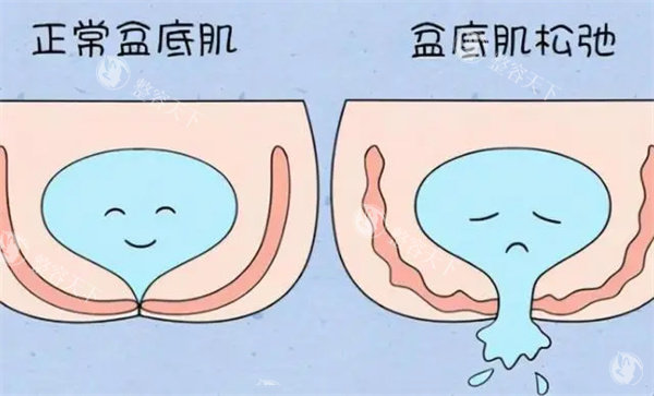 盆底肌修复医院怎么选？专科医生教你3个判断标准，产后修复不再走弯路！