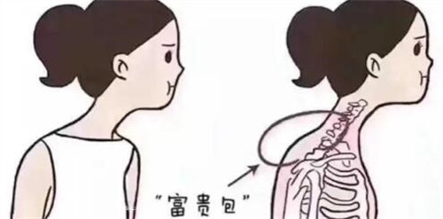 什么睡姿能减小富贵包？医师教你3个简单动作，轻松告别脖子后的大鼓包！