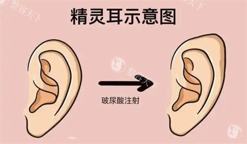 精灵耳整形前后对比图来了！术后3个月真实变化，这些风险要注意！