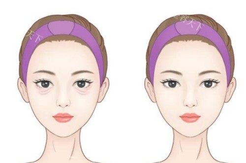 丽江激光去眼袋哪里好？悦莱美整形做各种类型眼袋都很难复发且医院资质技术都放心