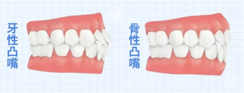 骨性凸嘴如何矫正或治疗？非手术以及手术方法帮你重回自信心！