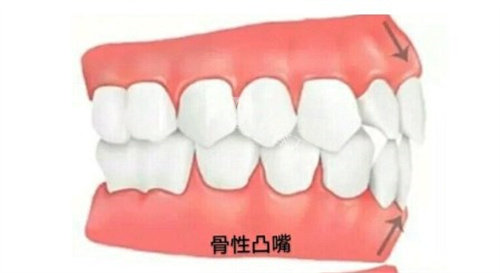 骨性凸嘴如何矫正或治疗？非手术以及手术方法帮你重回自信心！