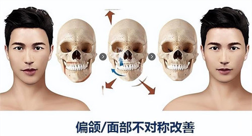 为什么医生不建议正颌手术？详细解析手术风险与替代方案
