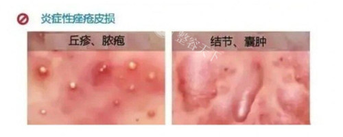 邯郸卫校皮肤科挂号预约指南：电话0310-313|8点开门营业少排队|湿疹痤疮找20年经验医师！