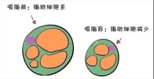 深圳吸脂出名的医生：曹孟君、钟伟洪、徐占锋、郑梦雄、黄奔、黄海侠在吸脂手术各有特色~