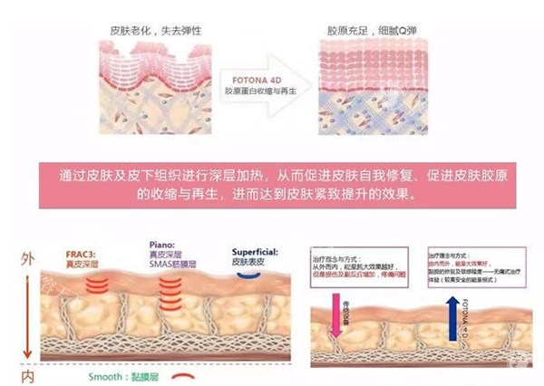 欧洲之星fotona4dpro功效详解，没有创口紧致抗衰的多方面解决方案