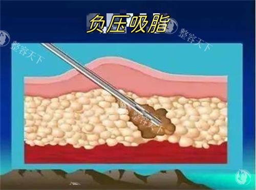 深圳抽手臂好的医生是谁？曹孟君、黄海侠、徐占峰、郭杰、刘富增、胡俊杰几位出名且技术高！