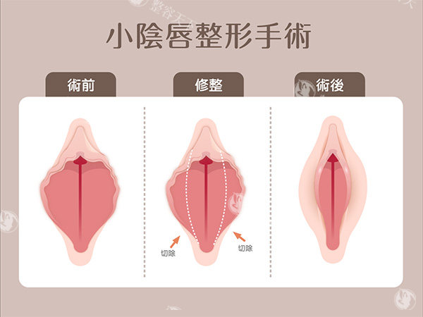 深圳私密整形手术多少钱？阴道紧缩术8000元起/小阴唇5000元起/私密漂红1500元起/处女膜修复3000元起~