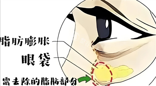 紫洁不开刀去眼袋价格表揭晓,超值性价比祛眼袋3800元起,轻度中度重度收费全揭底!