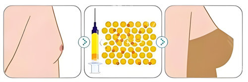 湖南医院自体隆胸比较有名的医生大揭秘：湘雅雷少榕5万起VS祺美肖征刚6.8万起